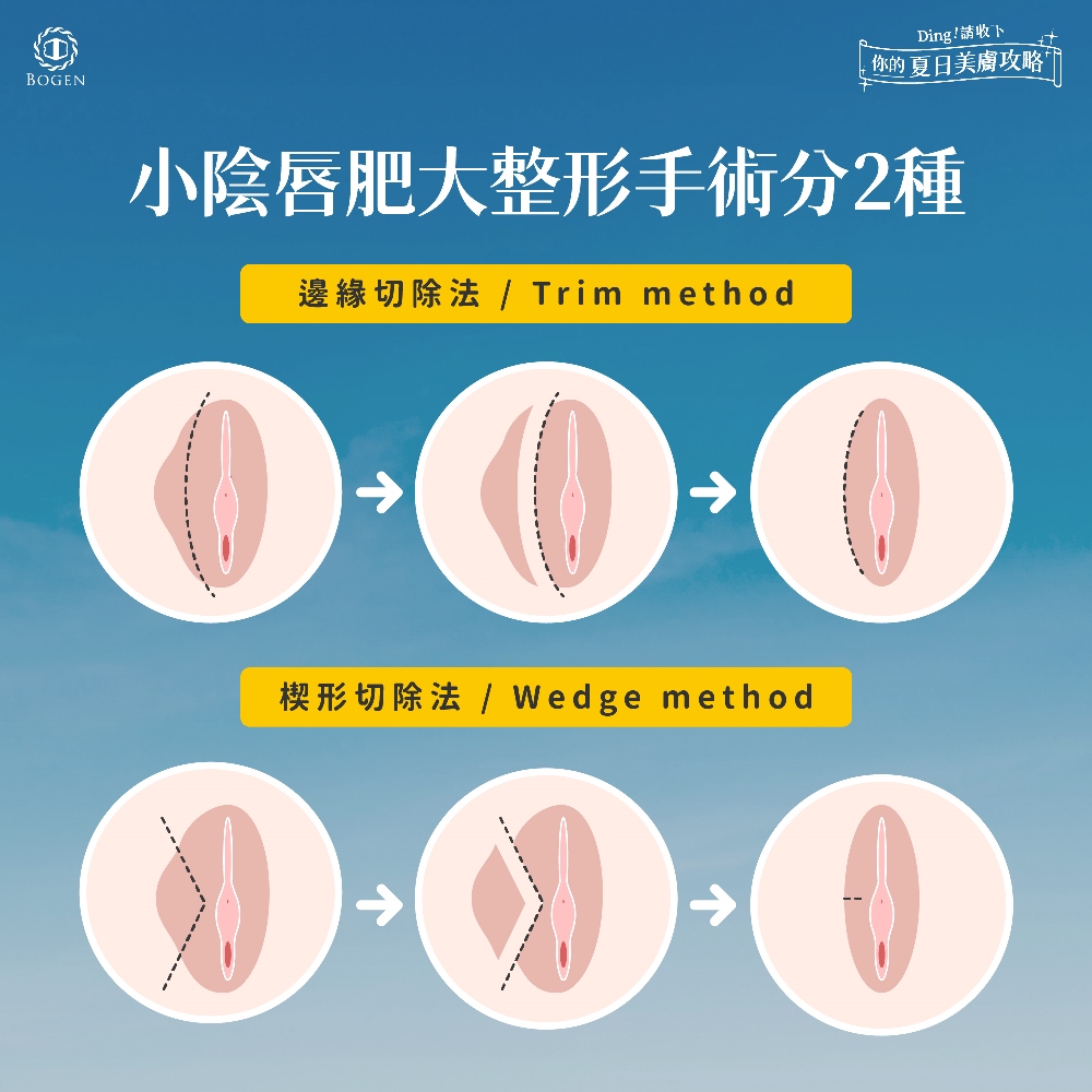私密處手術推薦小陰唇整形,推薦宋承嬡醫師,博恩妍